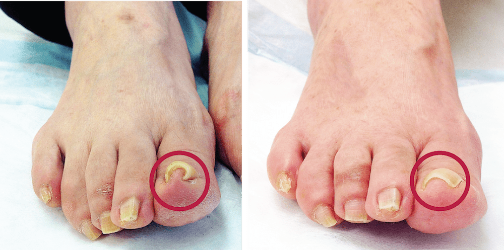 mika-hayashi-林美香足病科クリニック‐ニューヨーク-ingrown-nail-巻き爪
